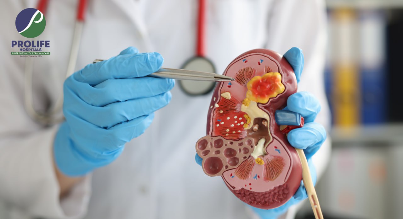 kidney stone removal