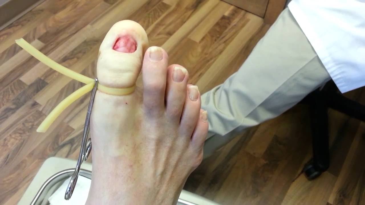 Toenail Removal