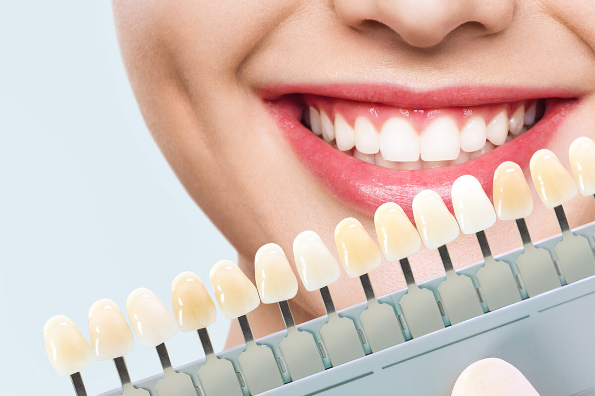 Transform Your Smile with Porcelain Veneers in Alexandria, LA