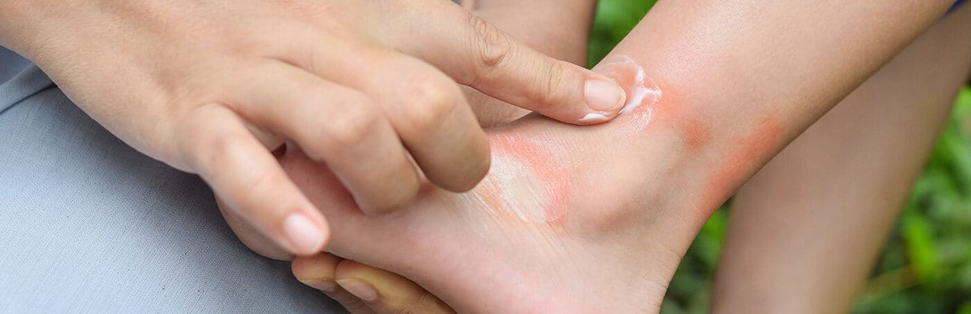 Treatment-for-Insect-Bites--1400x454