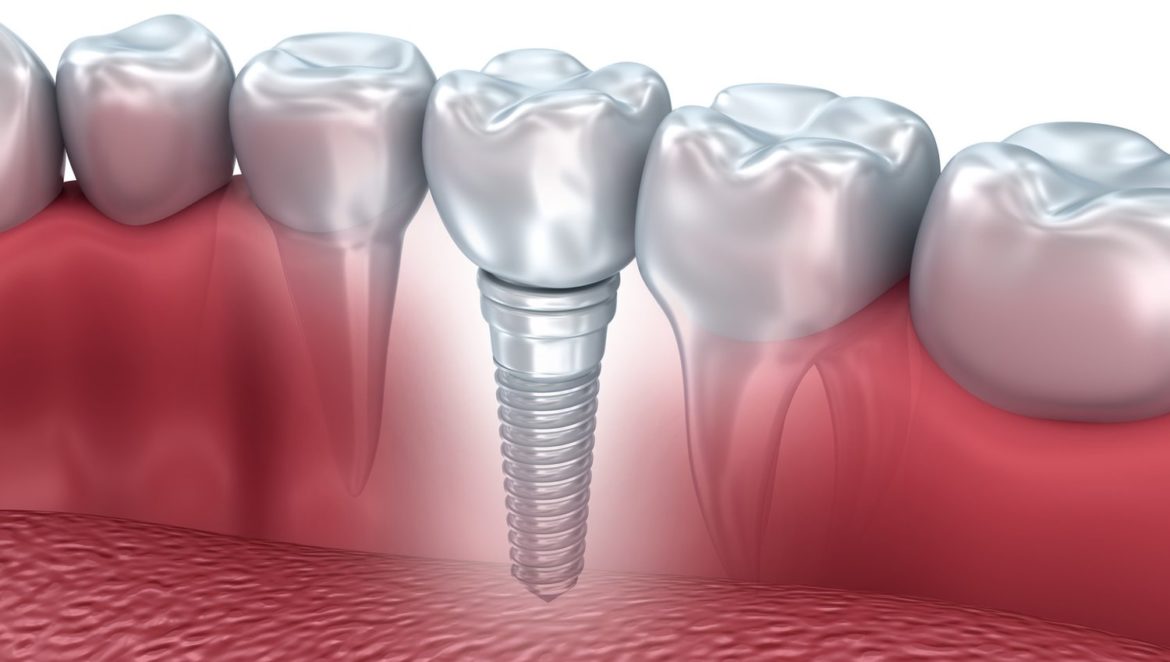 What You Should Know About Dental Implants
