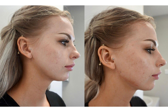 Jawline and Cheek Fillers