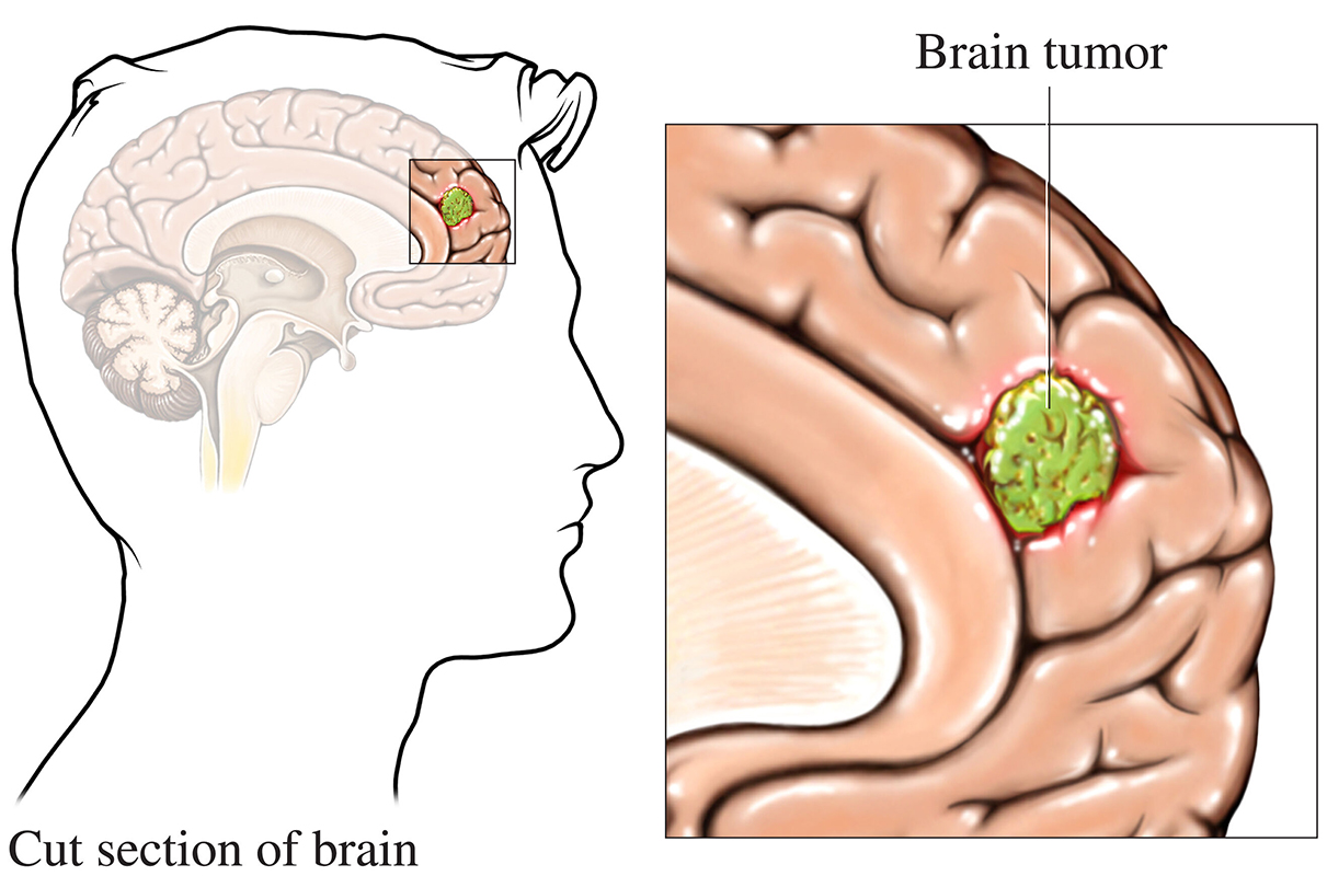 brain cancer symptoms
