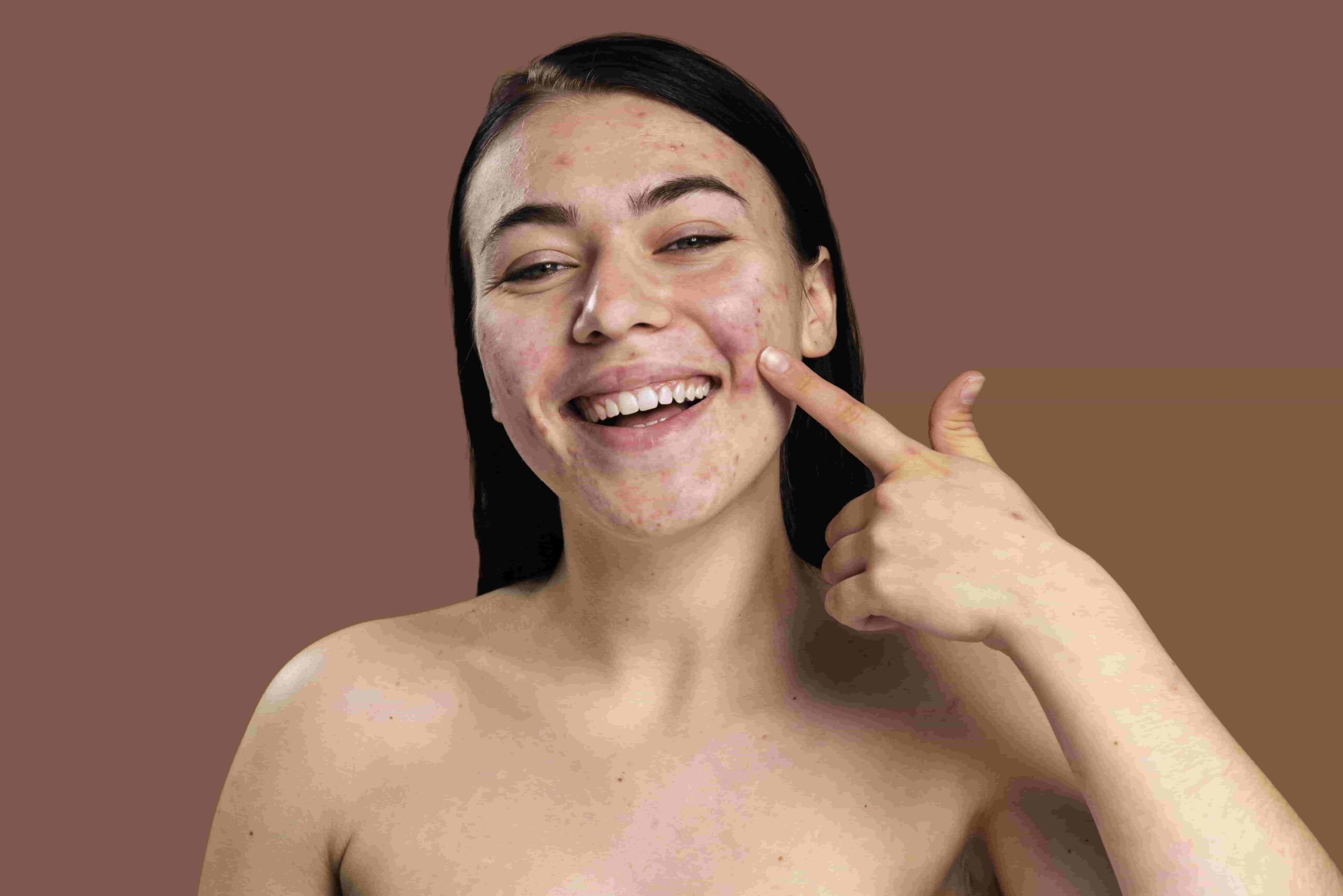 smiley-woman-showing-her-acne-with-confidence-min